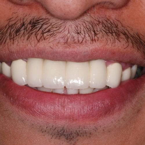 After Cosmetic Dentistry at Advanced Total Dental Care