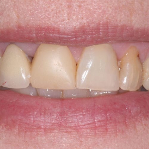 Before Cosmetic Dentistry at Advanced Total Dental Care