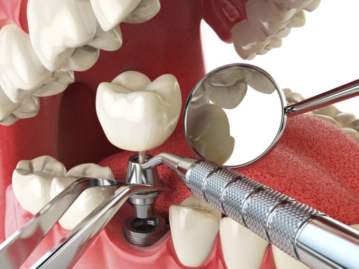 full service dental implants silver spring md implant dentist