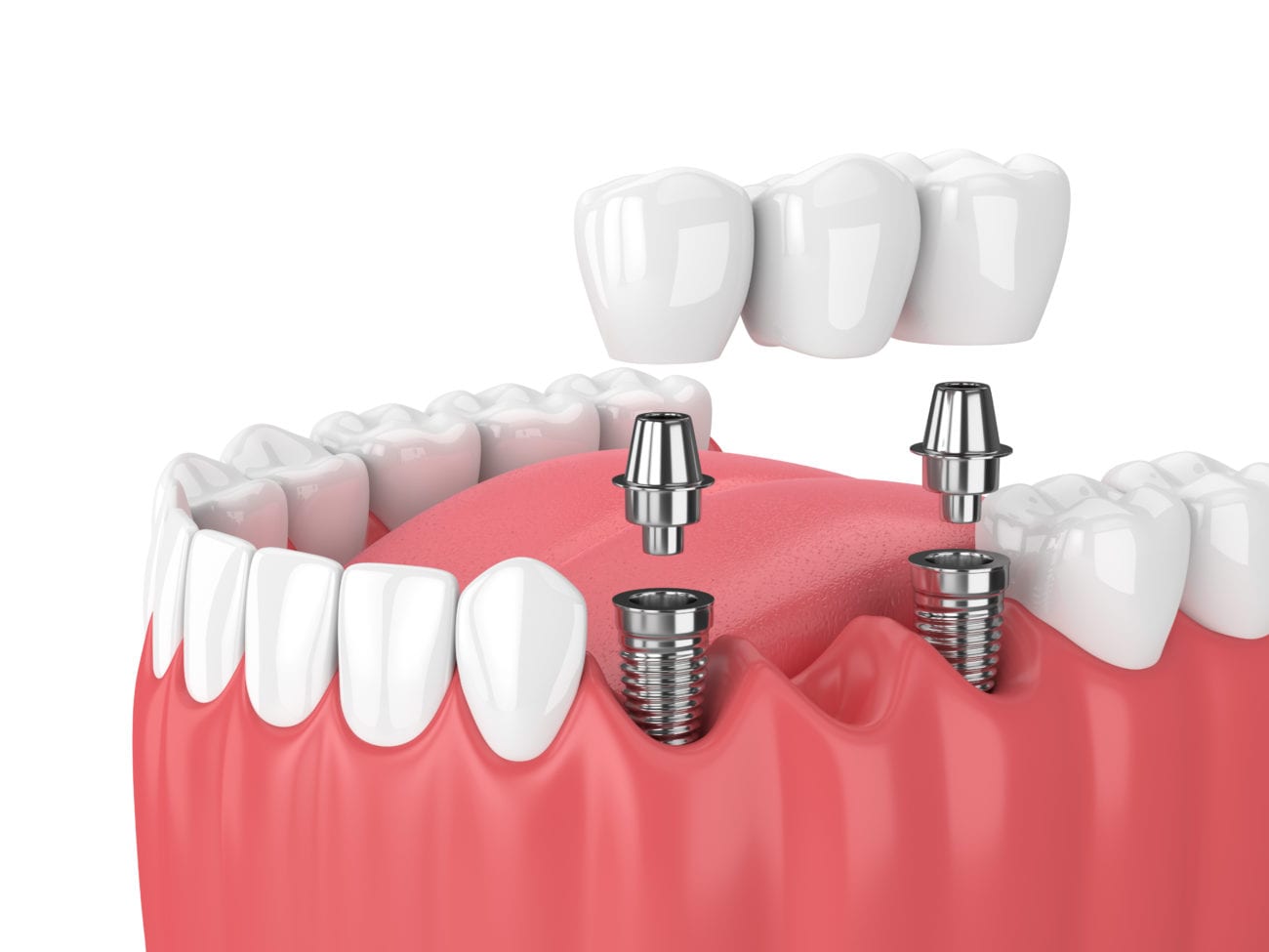 Dental Implant Process in Silver Spring, Maryland