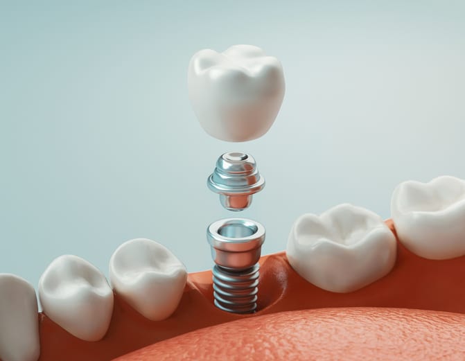 Affordable dental implants in Silver Spring, MD