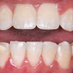 After Cosmetic Dentistry at Advanced Total Dental Care