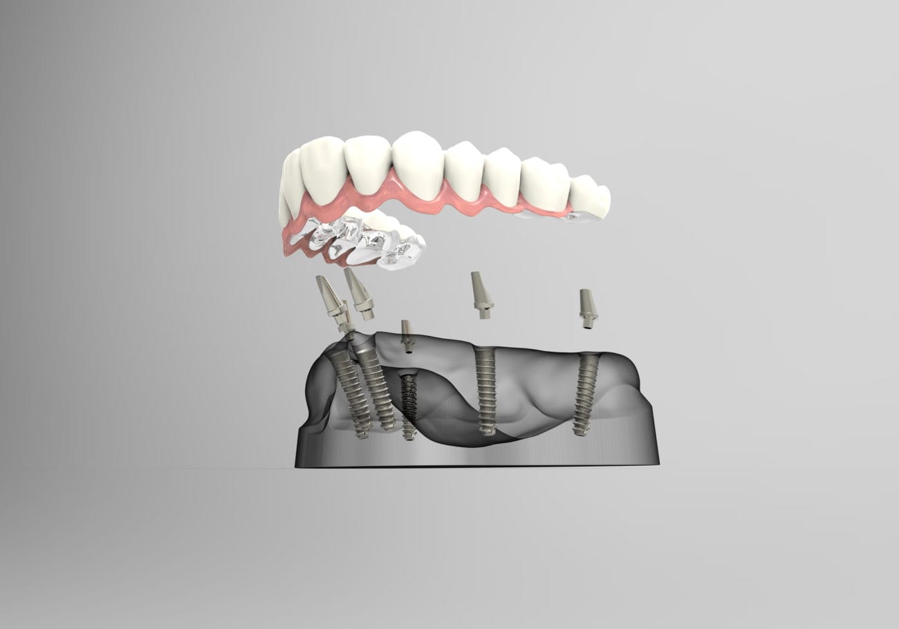 Multiple Dental Implants in Silver Spring MD