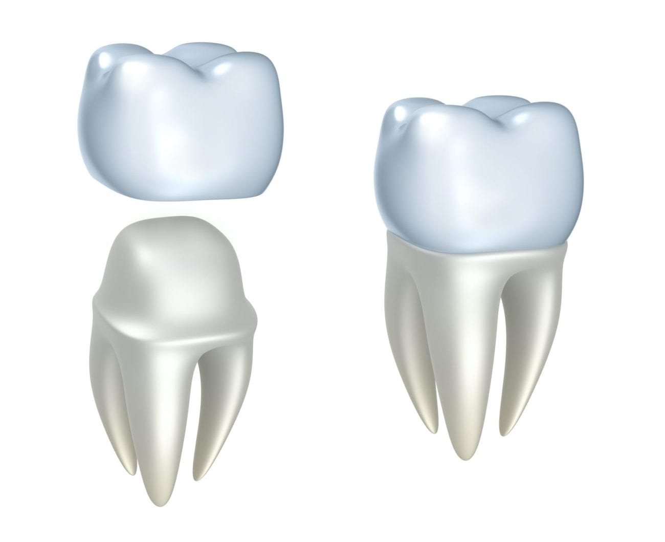 restorative dental crowns in Silver Spring Maryland