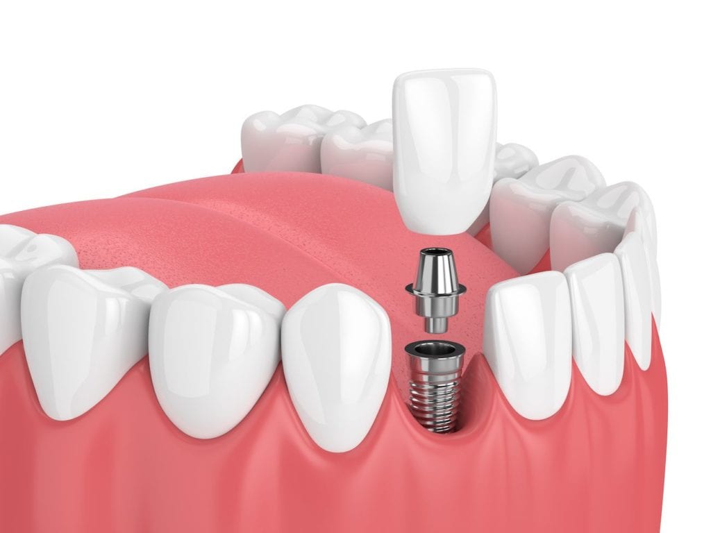 Why Replace Missing Teeth?