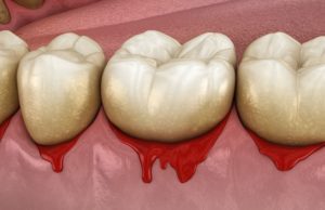 treat gum disease at your dentist in Silver Spring Maryland